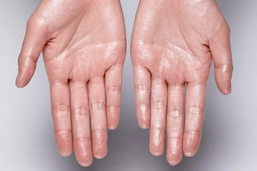 Hiperhidrosis palmar o sudor excesivo en las palmas de las manos. 