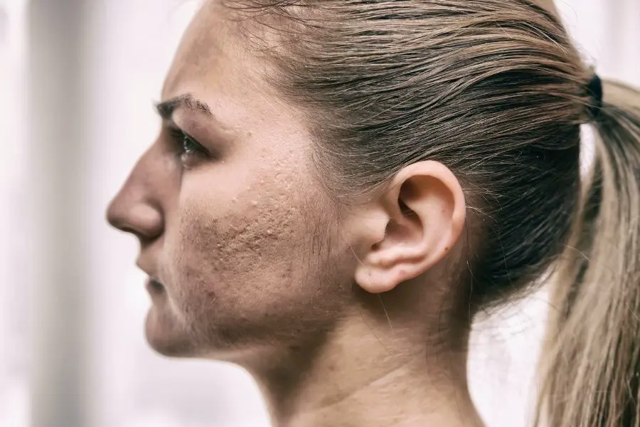 Eliminar marcas y cicatrices de acné: Tratamientos y recomendaciones.