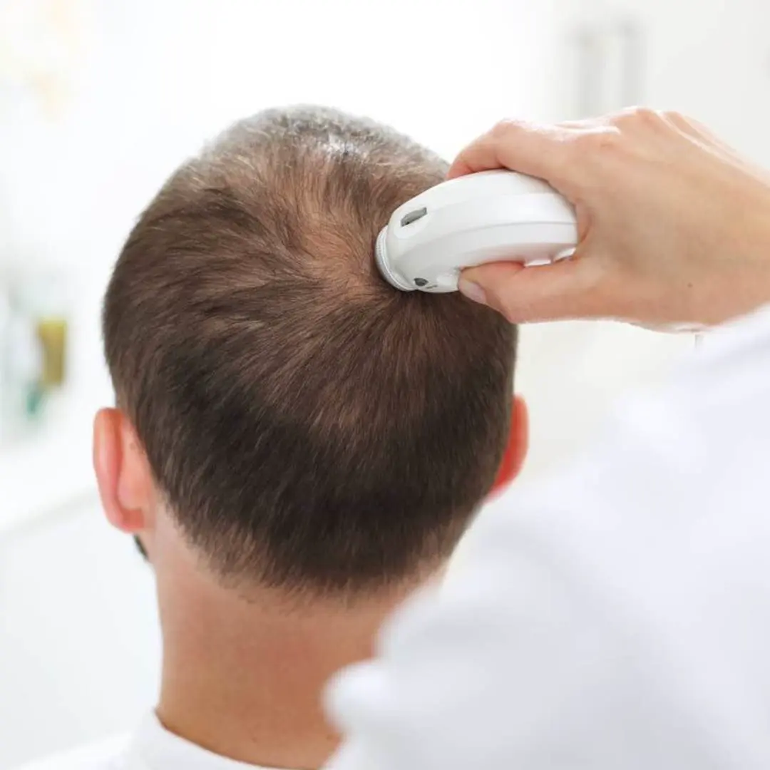 Tratamiento de mesoterapia capilar para frenar la caída de pelo estacional. 