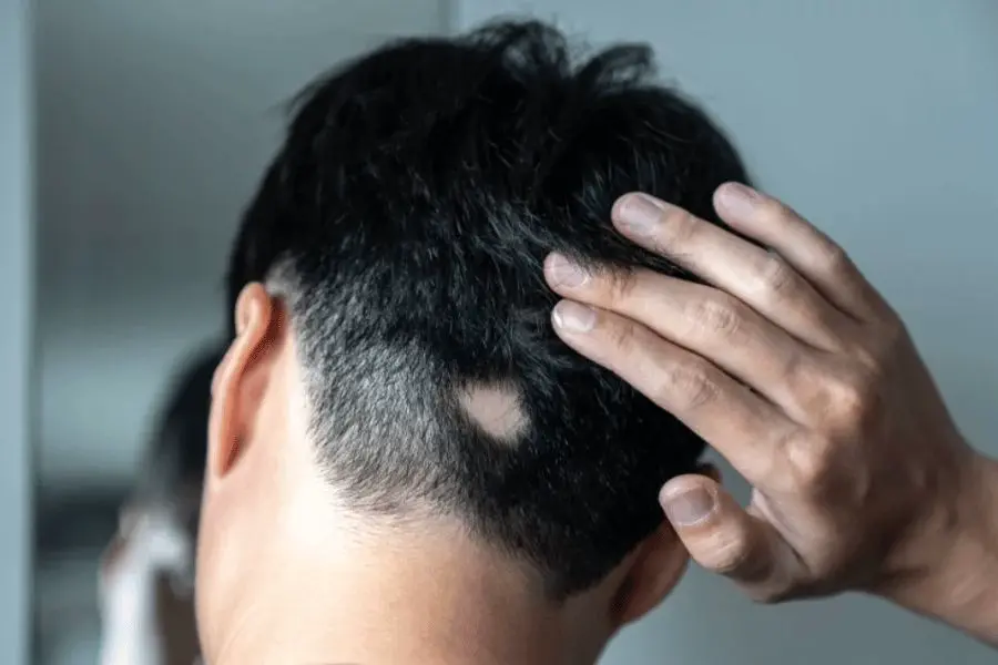 Alopecia areata: información y síntomas de este problema capilar.