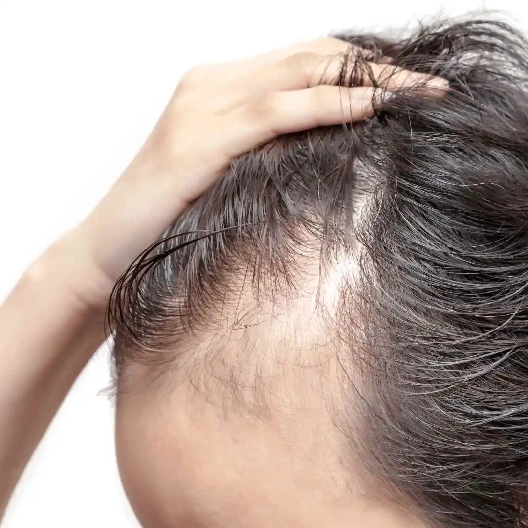 Tratamiento de mesoterapia capilar para frenar la caída de pelo estacional. 